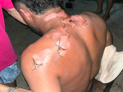 Mulher joga álcool e ateia fogo no corpo de marido em briga em MT